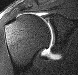 MRI SLAP Tear